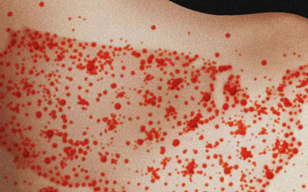 Scientists Find Measles Likely To Become Endemic in the US Over Next 20 Years