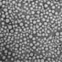 Drug-carrying nanoparticles shrink venous malformations by 70% in mice