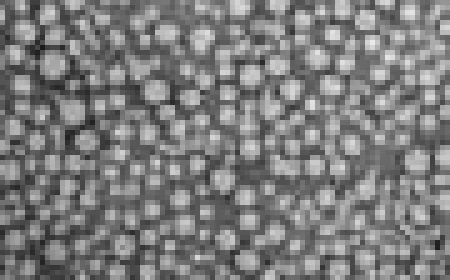 Drug-carrying nanoparticles shrink venous malformations by 70% in mice